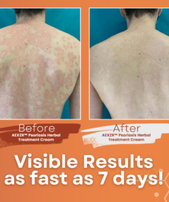 AEXZR™ Psoriasis Herbal Treatment Cream