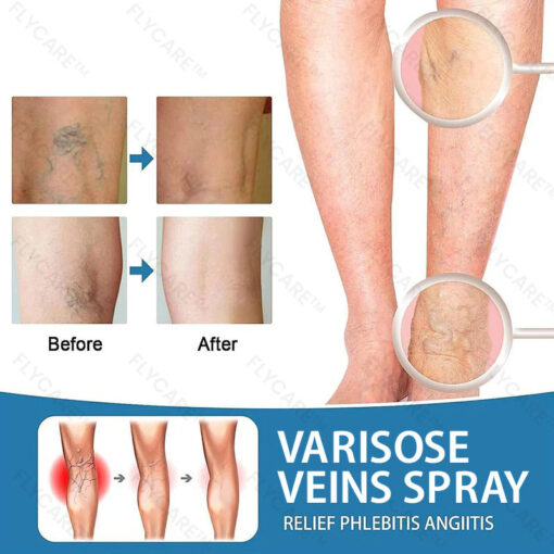 FLYCARE™ Varicose Veins Spray