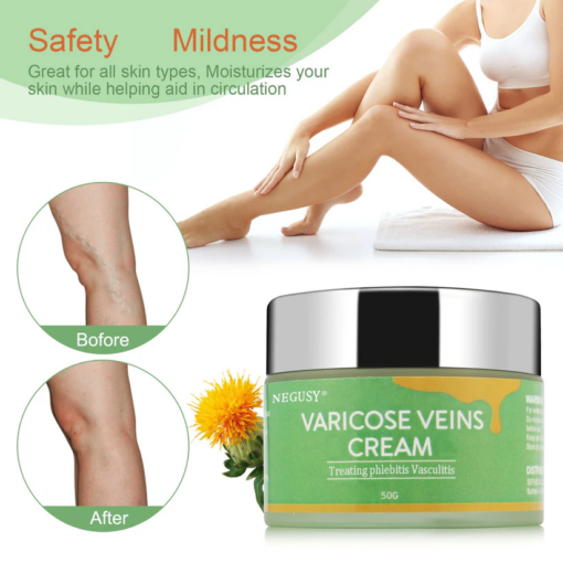 Negusy® Veins Cream: Complete Treatment for Varicose Veins