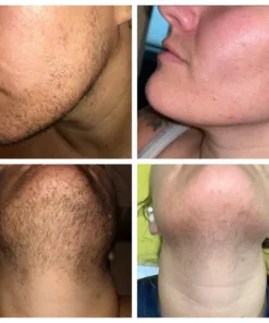 PCOS Facial Hair Natural Treatment At Home