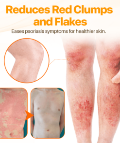 FLYCARE™ Psoriasis Anti-Bacterial Cream