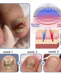 Furzero™ Advanced PureNail Fungus Laser Device