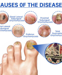 Furzero™ Advanced PureNail Fungus Laser Device