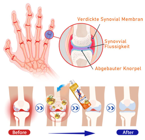 Furzero™ Turmeric Arthritis Spray