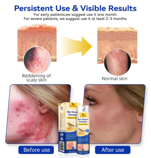 LOVILDS™ PsoriaHeal Bee Venom Psoriasis Treatment Spray