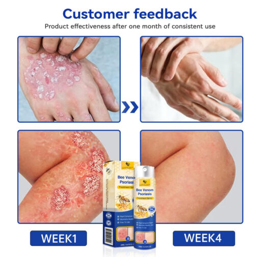 LOVILDS™ PsoriaHeal Bee Venom Psoriasis Treatment Spray