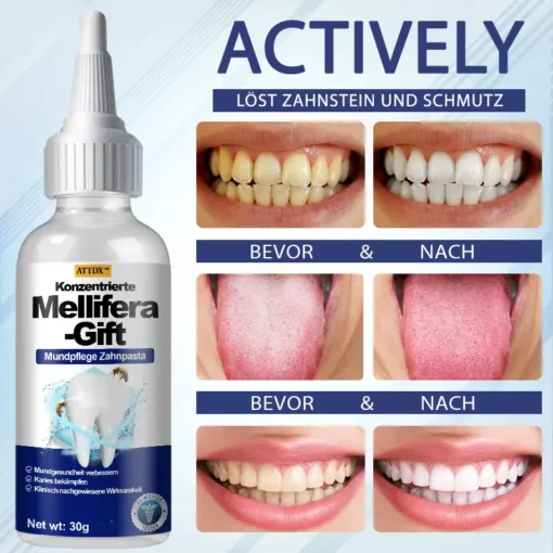 ATTDX™ Konzentrierte Mellifera-Gift Mundpflege Zahnpasta