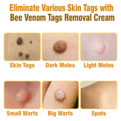 Lotmay™Australian Bee Venom Tags Removal Cream