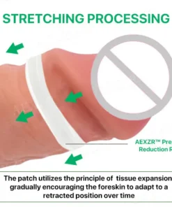 AEXZR™ Prepuce Reduction Ring