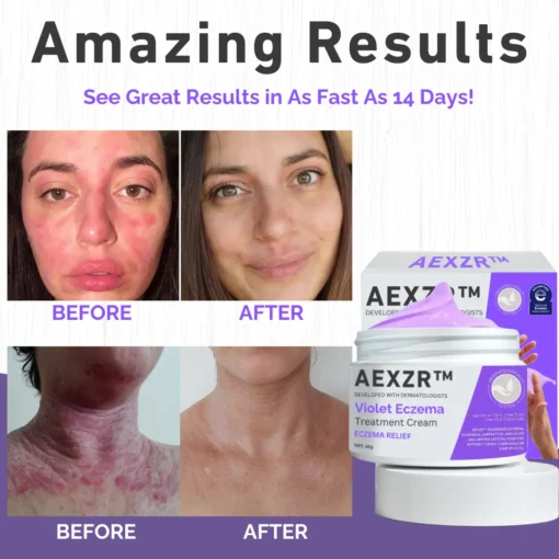 AEXZR™ Violet Eczema Treatment Cream