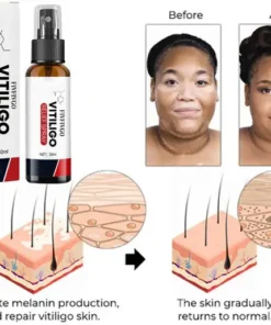 Fivfivgo™ Vitiligo Relief Spray