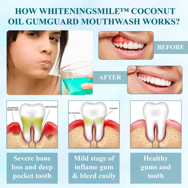 WhiteningSmile™ Coconut Oil GumGuard Mouthwash