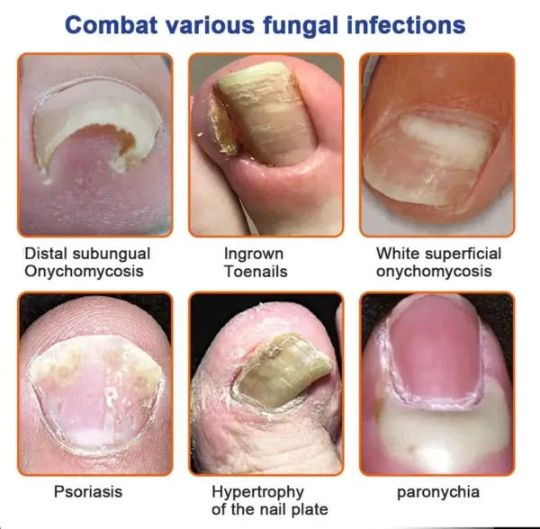 AEXZR™ Bee Venom Nail Fungus Treatment Solution