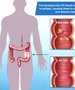 AEXZR™ Colon and Polyps Removal Cure