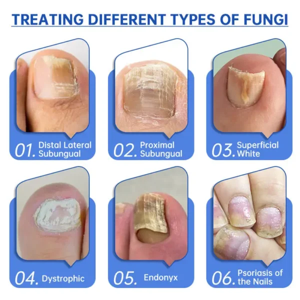 Bikenda™ PureNail Fungus Laser Device