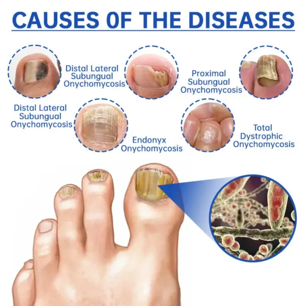 Bikenda™ PureNail Fungus Laser Device