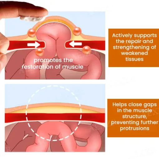 Enzyil™ Hernia Treatment Cream - Image 4