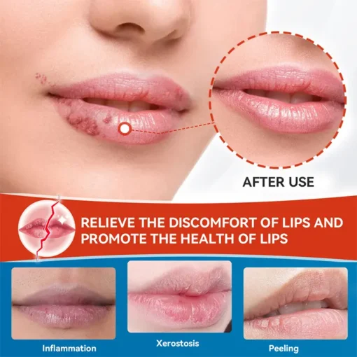 LIMETOW™ Cheilitis Cream - Image 3