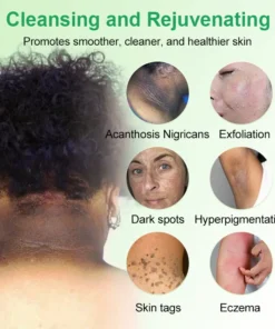 Purifying Exfoliating Gel for Acanthosis Nigricans